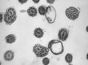 M,12y. | immotile cilia syndrome - nasal mucosa